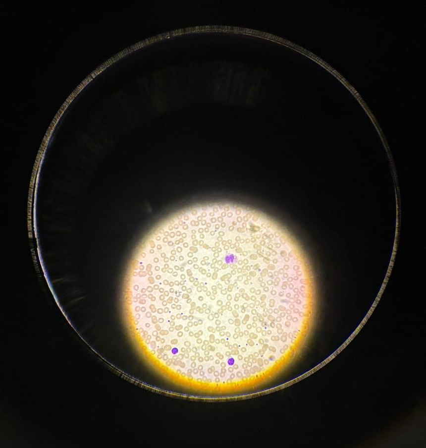 Peripheral blood smear viewed under microscope