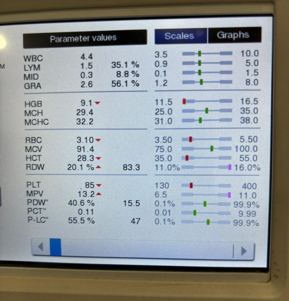 CBC parameter values displayed on hematology analyzer