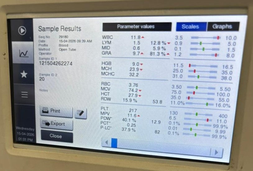Complete blood count results on analyzer screen